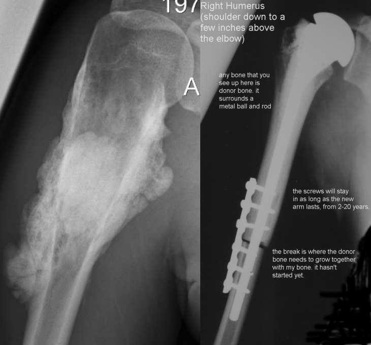 An x-ray before and after humerus resection