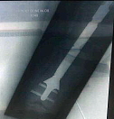 An X-ray of Justin's leg